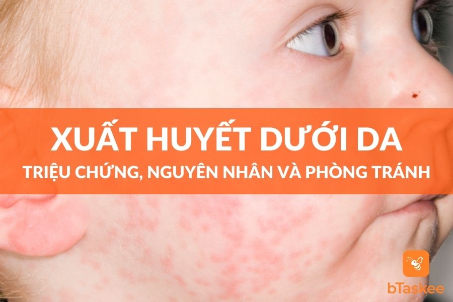 Xuất Huyết Dưới Da - Triệu Chứng, Nguyên Nhân Và Điều Trị