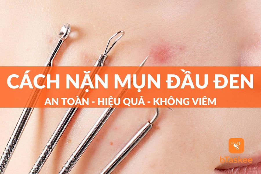 Cách Nặn Mụn Đầu Đen An Toàn - Hiệu Quả - Không Viêm