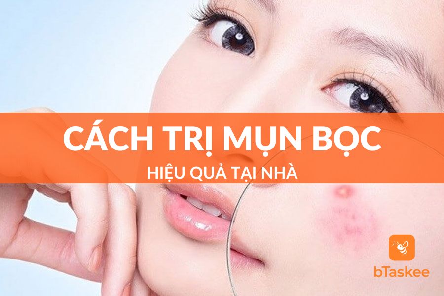 7 Cách Trị Mụn Bọc Tại Nhà Cực Hiệu Quả, Không Để Lại Sẹo